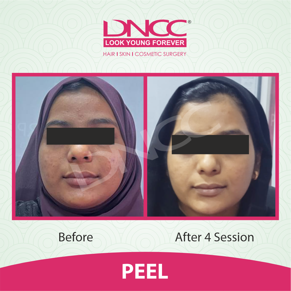 Hair Transplant Transformation 1